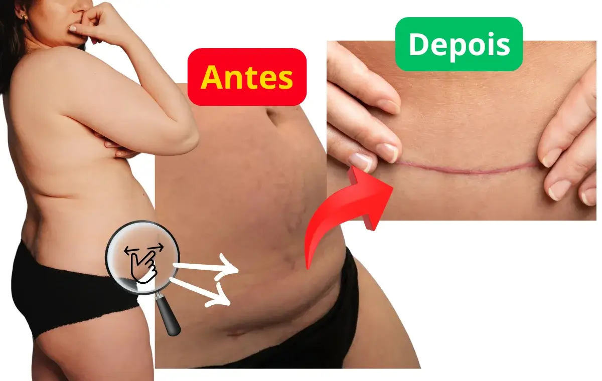 Before-and-after comparison of the C-section belly and scar area from the original program