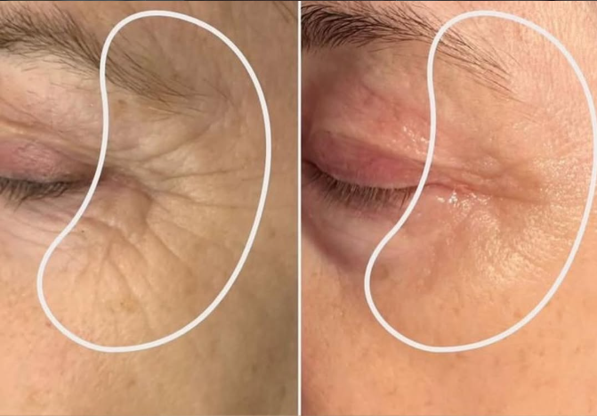 Before and after face area